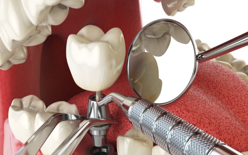 Understanding the Role of Titanium in Dental Implants: Strengths and Benefits 2 Understanding the Role of Titanium in Dental Implants: Strengths and Benefits