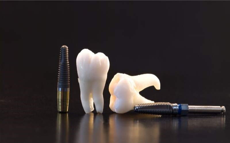 Understanding the Role of Titanium in Dental Implants: Strengths and Benefits